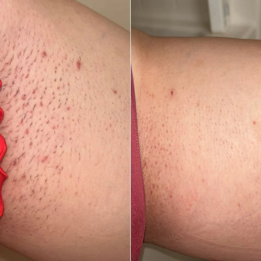 the Peacher Dermaplane Razor