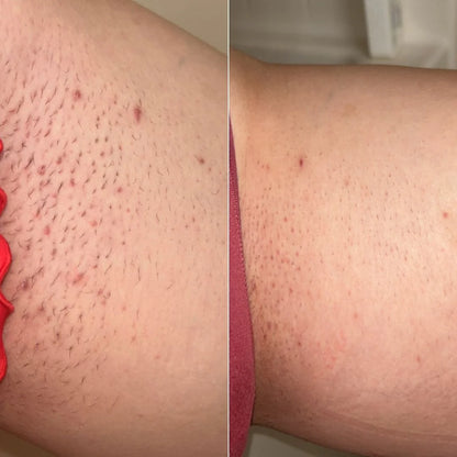 the Peacher Dermaplane Razor